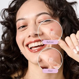 Her Parches para Acné Pimple Patches Ultra Finos y Discretos Hidrocoloide con Ácido Salicílico e Hialurónico 24 Piezas de 10mm Reducen Inflamación y E