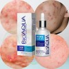 Bioaqua Serum Pure Skin Retira Acne Y Espinillas Regenera