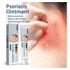 //arx Crema Antimicótica Para La Tiña Inguinal