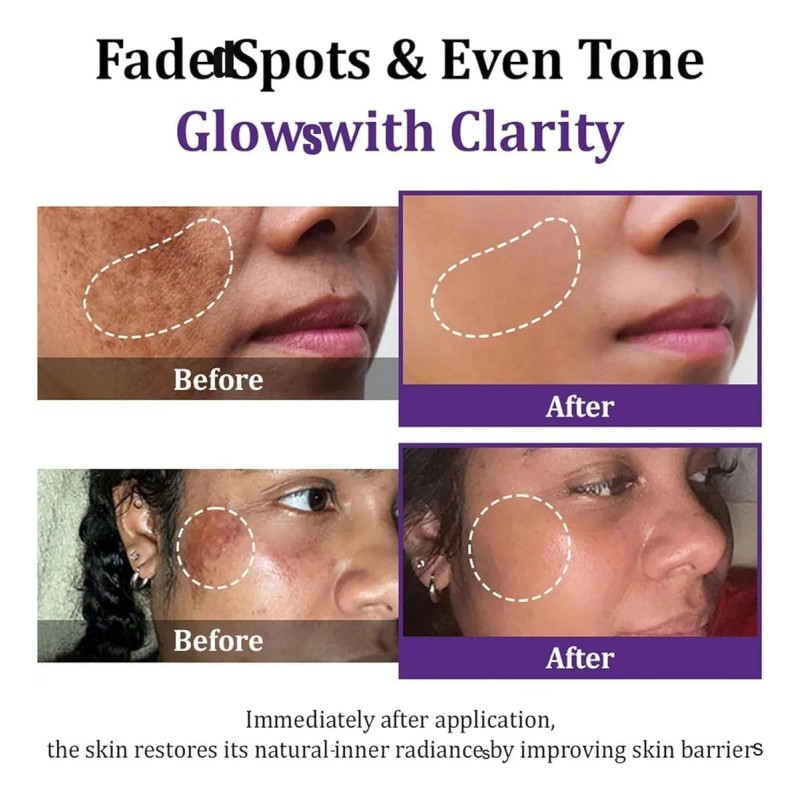 Crema Epiglow Melanex Advanced Anti-hiperpigmentación