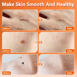 Damaile EU Skin Tag Removal Cream, 20g Verruca Treatment, Effective and Safe Skin Tag Remover, Wart Remover for Smooth Skin, Gentle Corn Remover for Feet Hands, Mole Remover for Skin Care