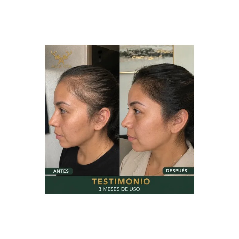 1 Shampoo Anticaída Y Crecimiento Chile Y Romero Vital Root