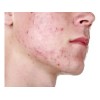 Treeactiv Crema Facial Acné Tratamiento Natural Promoción 3x