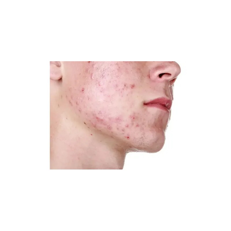 Treeactiv Crema Facial Acné Tratamiento Natural Promoción 3x