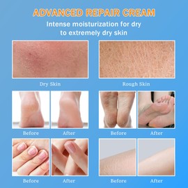 Urea Cream 60% - Urea Foot Cream with Moisturizing Heel Socks for Dry Cracked Hands Heels, 60 Percent for Feet Maximum Strength with 2% Salicylic Acid, Jojoba Oil, Aloe Vera, 5.31oz (Blue, 5.3oz)