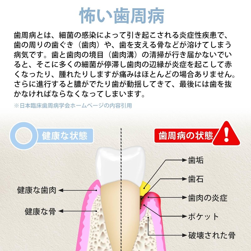 クリーニングキット 歯用ツール 自宅用 家族用 デンタルミラー スケーラー 舌ブラシ ステンレス鋼製 収納ケース付き 五点セット