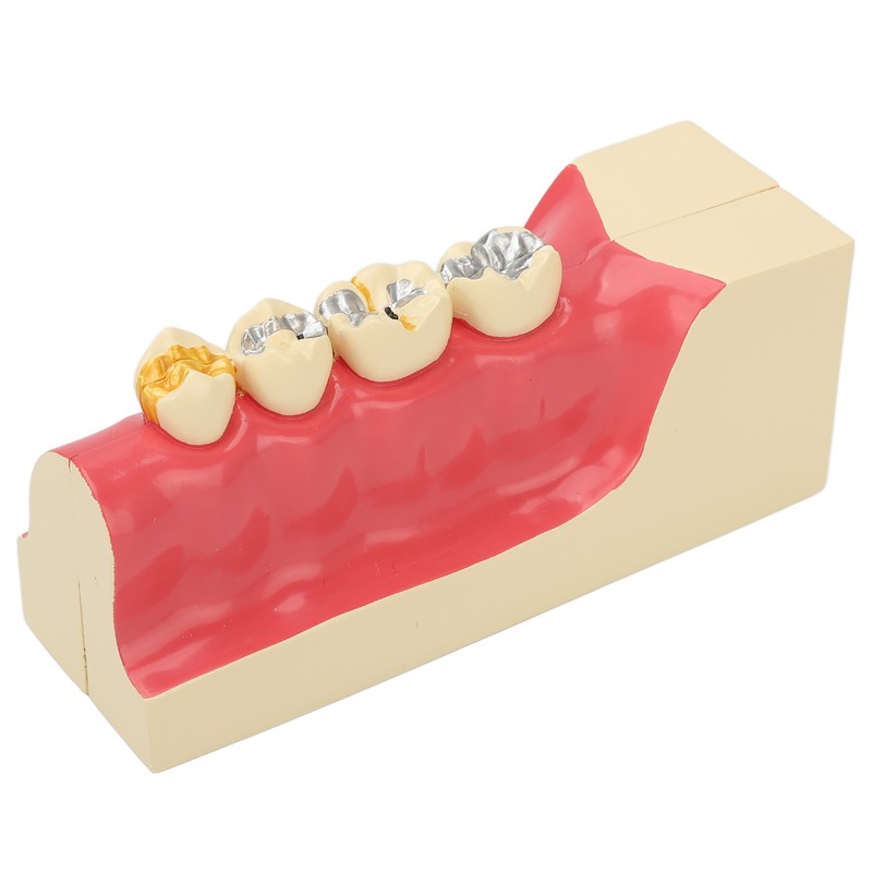 Right Lower Posterior Tooth Model 2X Magnification Detachable Resin Tooth