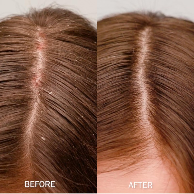 SACHAJUAN Scalp Shampoo | Anti-Dandruff Shampoo for Dry, Itchy Scalp