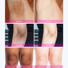 Kojic Acid Cream – Brightens Underarms, Knees, Inner Thighs & Intimate Areas. Dark Spot Corrector for Body, Armpits & Acanthosis Nigricans. Lightens & Evens Skin Tone