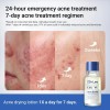 T; Loción Acne Buster, Ácido Salicílico Para El Acné Y