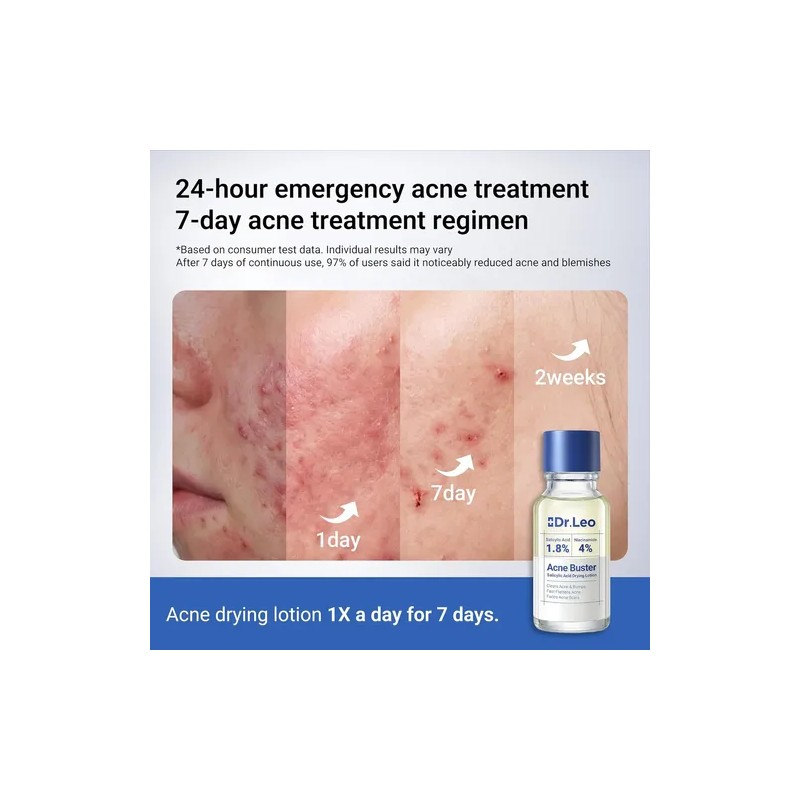 T; Loción Acne Buster, Ácido Salicílico Para El Acné Y