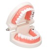Dental Disease Caries Teeth Model Resin Simulation Teaching Prop Dental