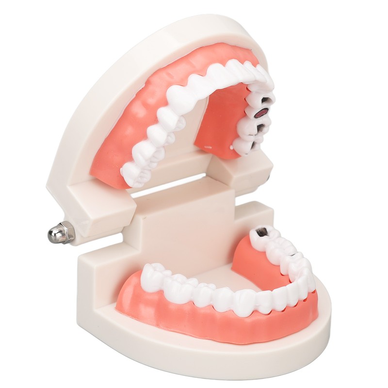 Dental Disease Caries Teeth Model Resin Simulation Teaching Prop Dental