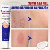 Crema De Tratamiento Psoriasis Para Picazón Y Escamosa