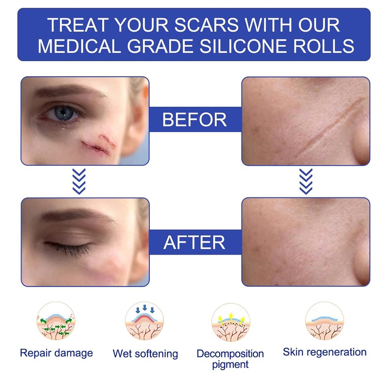 Self-adhesive Silicone Scar Patch 1.6x120 inches Transparent Invisible Scar Sheets