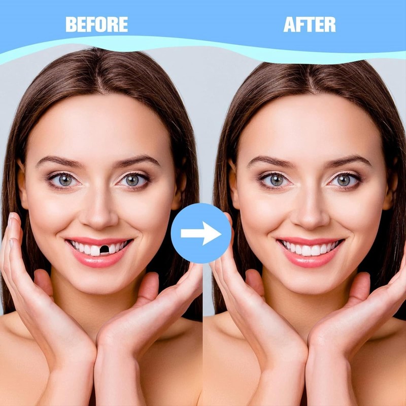 Instant Veneers Dentures,Clip in Veneers Teeth,Snap on Veneers Teeth,Fake Braces,False