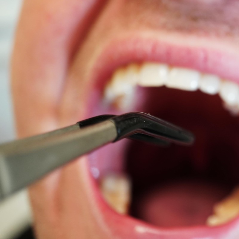 Generic Premium Tonsil Stone Remover Kit, Metallic