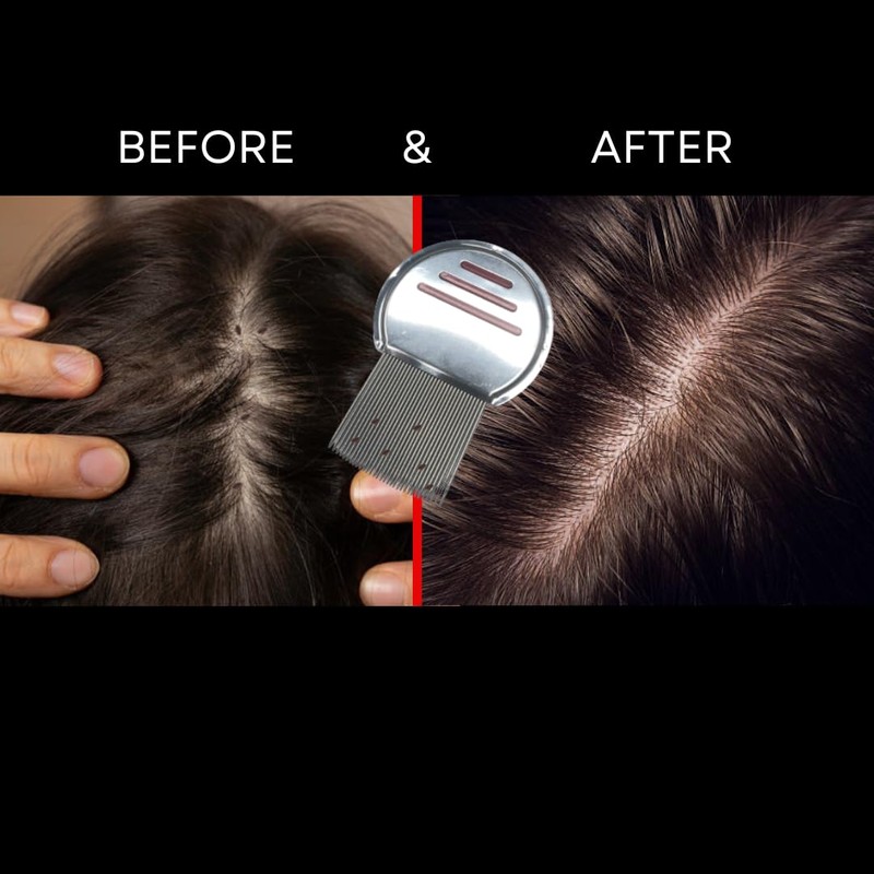 NitKill 10 Pack Lice Comb