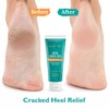 Urea Gel 42 Percent For Feet Maximum Strength Softens Cracked