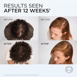 L'Oreal Paris ELVIVE Growth Booster Shampoo 200ml, Anti Hair Loss Shampoo for Men & Women, with Aminexil & Niacinamide, Prevents & Reduces Hair Loss and Hair Thinning, Visibly Denser in up to 12 weeks