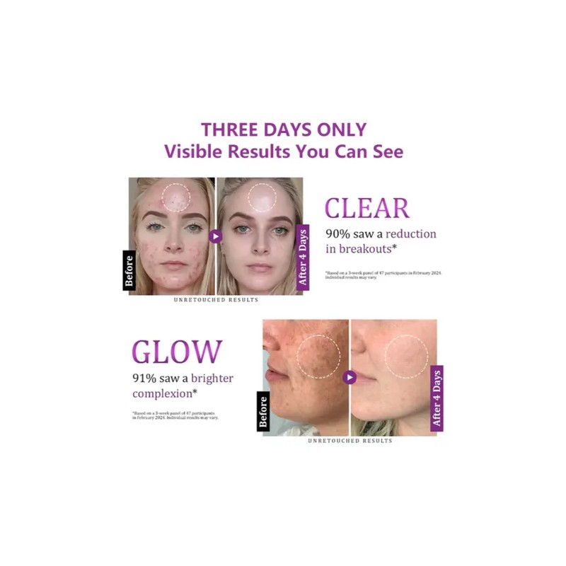 Highly Effective Anti-pigmentation Serum Whitening Blemish R
