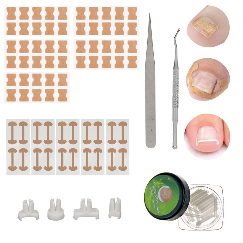 Ingrown Toenail Treatment Kit Glue Free Pedicure Ingrown Toenail Corrective