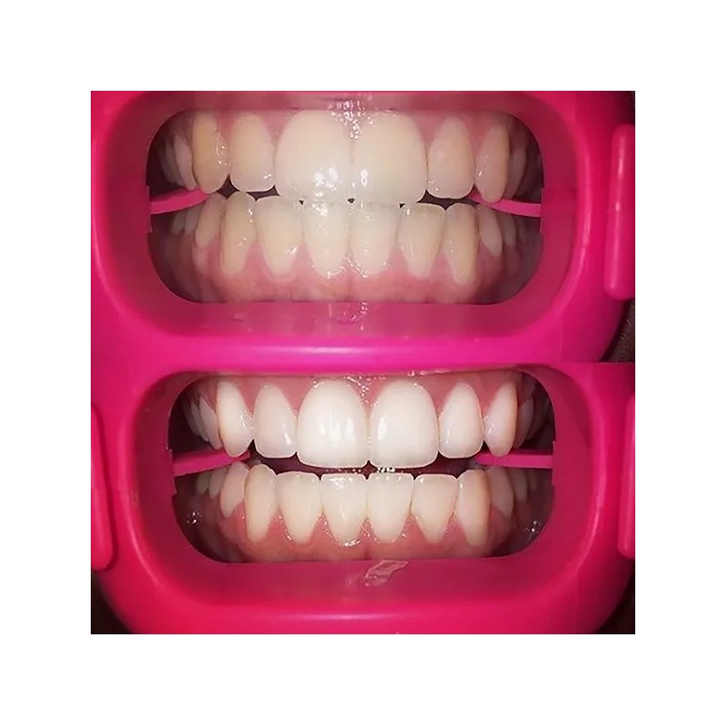 Twilight Teeth P6 Whitener Gel Refill 3.5ml, 10 to 12