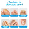 Tratamiento Rápido De Hongos En Las Uñas De Los Pies