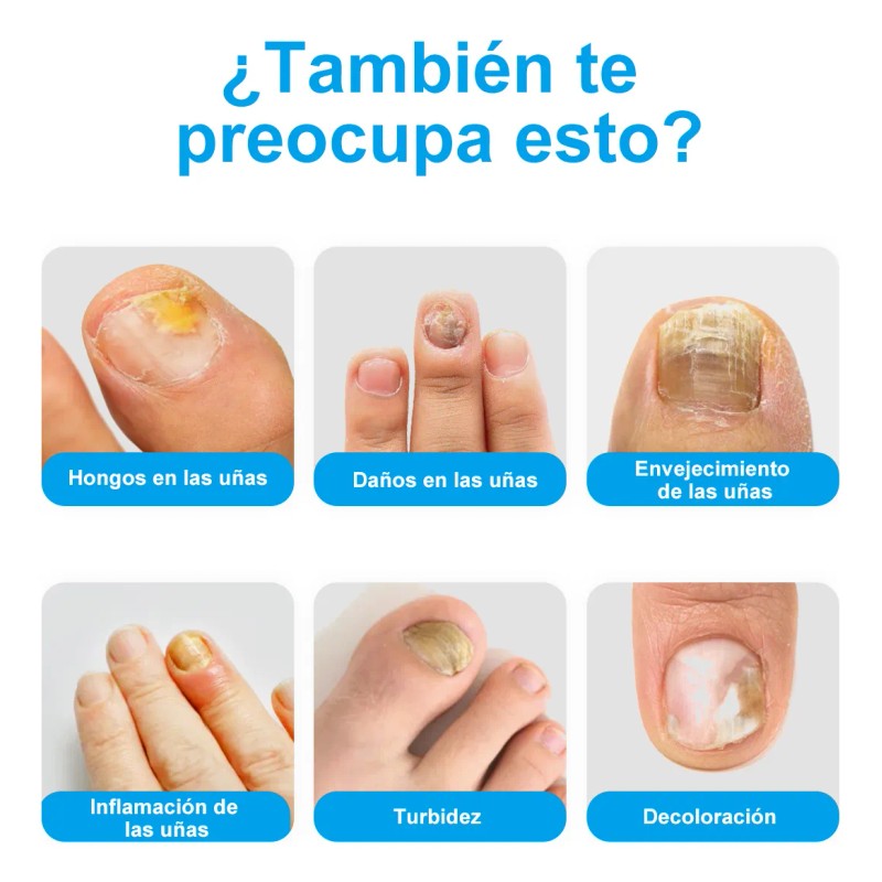 Tratamiento Rápido De Hongos En Las Uñas De Los Pies