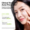 Anua [Anua]Azelaic Acid Cica Skin Soothing Moisturizer 100ml