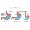 Melox for Heartburn Relief