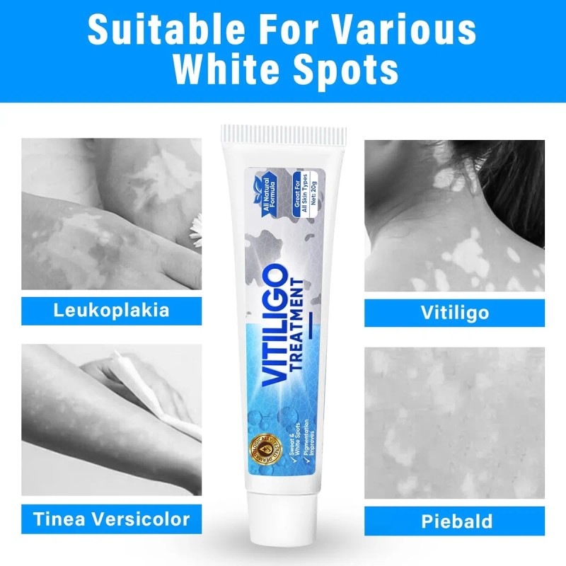 Tratamiento De Vitíligo, Tratamiento Natural De Crema De Vit