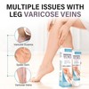 Varicose Veins Treatment for Legs, 2 Count Varicose Veins Treatment