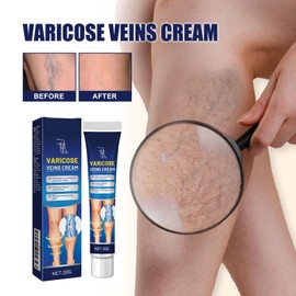 Captree Varicose Veins Cream, Varicose Veins Treatment for Legs, Eliminate and Relieve Varicose Veins, Relieve Itching and Pain, Improves Blood Circulation, 20g