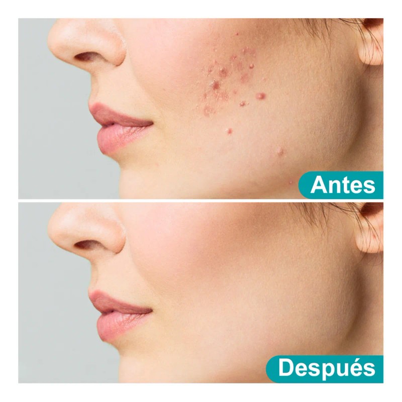 Gel Facial Anti-imperfecciones Tipo De Piel Acne