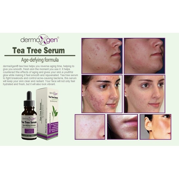 Tratamiento del acné del suero del árbol del té 100% natural Anti acné cicatriz