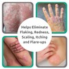 Dr. Blaine’s REVITADERM Psoriasis Formula - Soothing Topical Cream with