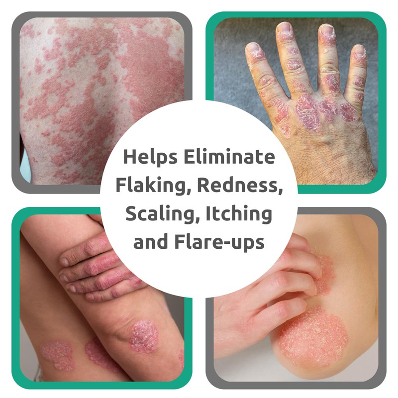 Dr. Blaine’s REVITADERM Psoriasis Formula - Soothing Topical Cream with