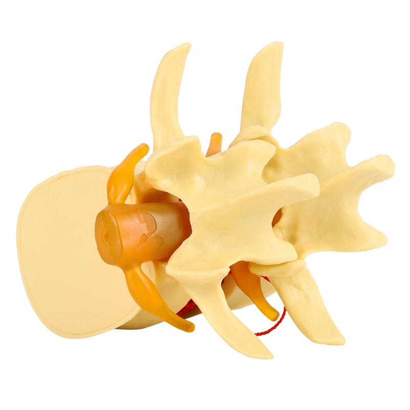 1:1.5 Anatomical Medical Human Spine Lumbar Disc Herniation Demonstration Model