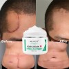 Crema Apoyo Desvanecimiento Cicatrices Cacarizos Queloides