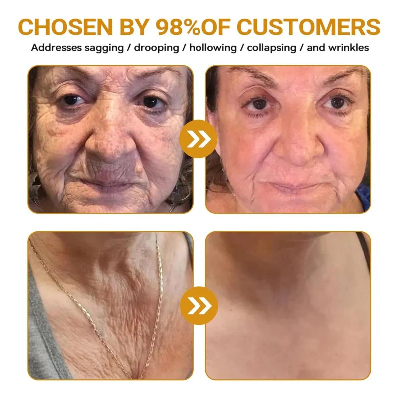 Mzhl Crema Awzlove For Reducir Las Imperfecciones De La