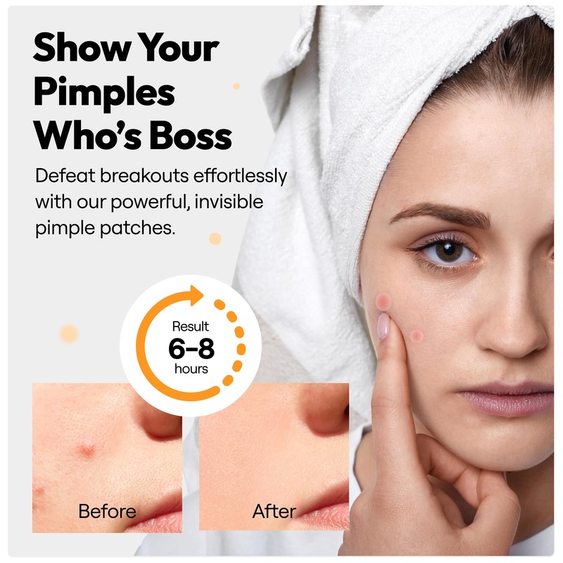 300 Pimple Patches – Hydrocolloid with Salicylic Acid, Tea Tree