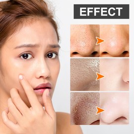 80 Pcs Blac/khead Remover Strips,Charco/al Pore Strips,Deep Cleansing Nose Str/ips Blac/khead,Nose Patches for Pores,Removes Bla/ckheads and Unclogs Po/res for Women and Men,Gentle and Skin-friendly