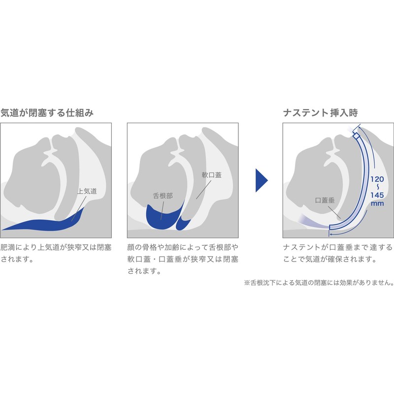 いびきを防ぐ一般医療機器：ナステント クラシック (右125mm Soft)