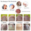 6 in 1 set Ingrown Toe Nail Fixer Pedicure Toenail