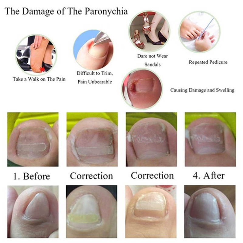 6 in 1 set Ingrown Toe Nail Fixer Pedicure Toenail
