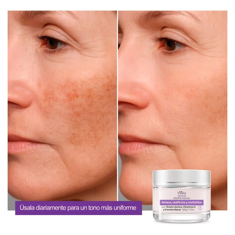 Crema Despigmentante Para Manchas, Melasma, Acné Y Paño 50g