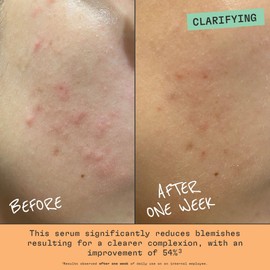 cleanjourney Niacinamide Blemish Serum for Acne-Prone Skin, Significantly Reduces Blemishes for Clearer Complexion, EWG Verified & Dermatologically Tested, Fragrance-Free, Vegan, Unscented, 1 Fl Oz