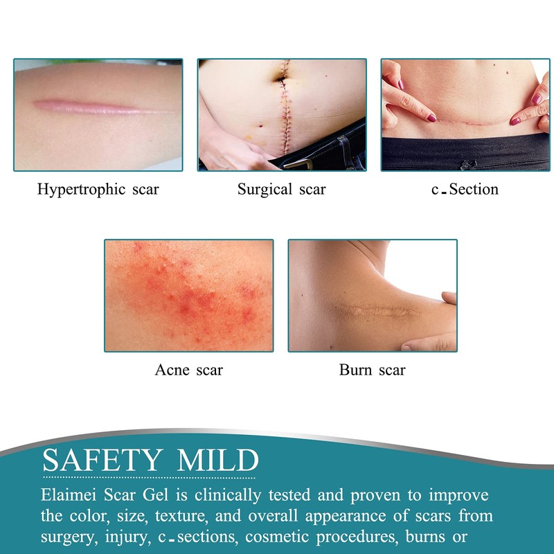 Medical Grade Silicone Scar Sheets, Silicone Scar Tape (1.6”x 60”),