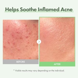 TOSOWOONG - Suero facial con 10 % de ácido azelaico, 33 ml/1.11 oz, calma el enrojecimiento e imperfecciones, centella asiática para acné, niacinamida